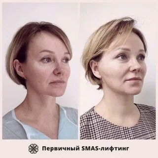 Смас аппаратный