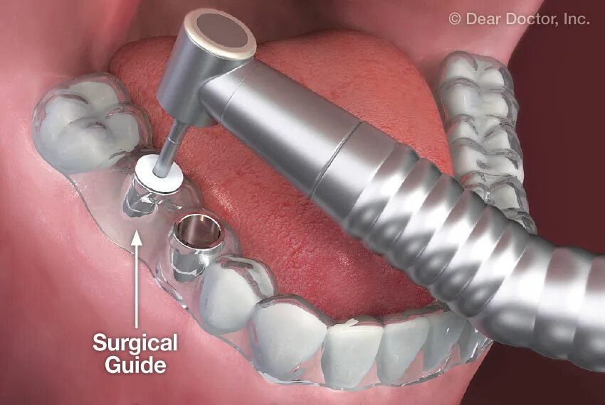 Guided surgery. Guided surgery. Megagen импланты. Rafed healthcare uae. Возможности современной имплантологии.