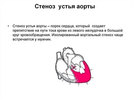 Аорта недостаточность и стеноз