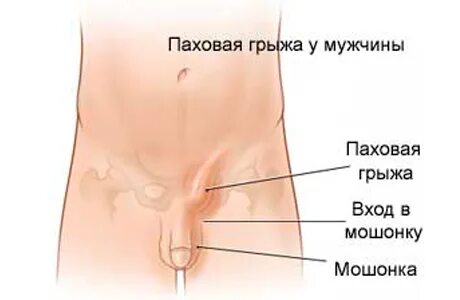 Почему грыжа появляется после
