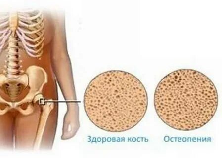 Остеопенический синдром