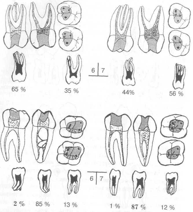 1 Моляр нижней челюсти анатомия корневых каналов. Анатомия корневого канала второй моляр верхней челюсти. Топография устьев корневых каналов зубов нижней челюсти. 1 Моляр нижней челюсти эндодонтия.