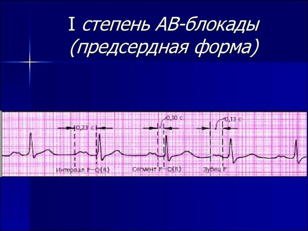 Что значит внутрипредсердная внутрипредсердная блокада. Внутрипредсердная блокада на ЭКГ. АВ блокада 1 степени предсердная форма. Проксимальная АВ блокада. Проксимальная АВ блокада 1 степени.