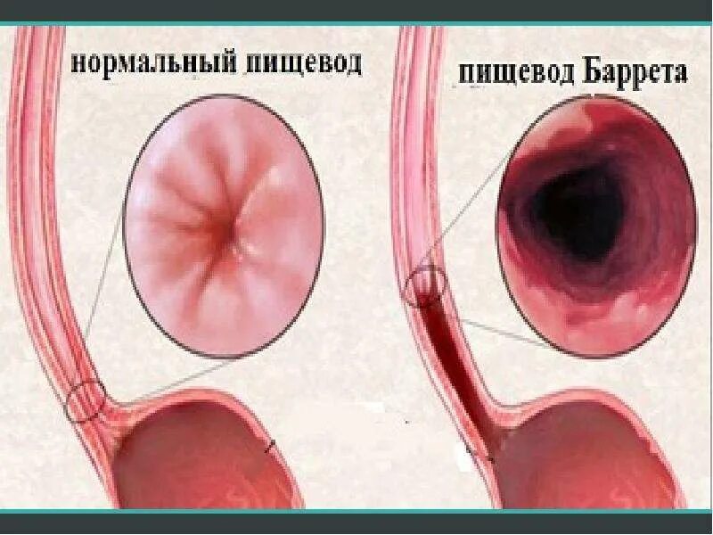 Барретта симптомы и лечение. Пищевод барретта эндоскопия. пищевод барретта дисплазия. пищевод баррета характеризуется метаплазией.