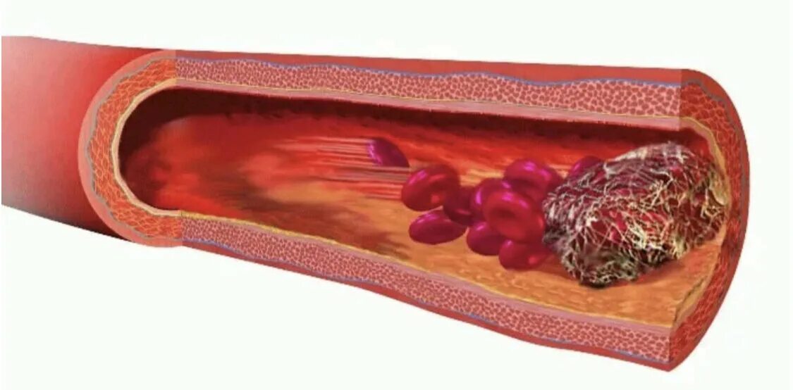Кровь закупорка сосудов. Тромбоз кровеносных сосудов. Тромбоз и эмболия и атеросклероз. Эмболия это закупорка кровеносных сосудов.