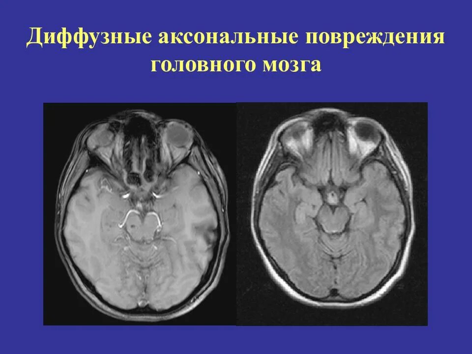 Диффузное аксональное повреждение кт. Диффузно аксональные повреждения головного мозга. Диффузное аксональное повреждение мозга кт. Диффузное аксональное повреждение головного мозга последствия. Диффузная травма мозга