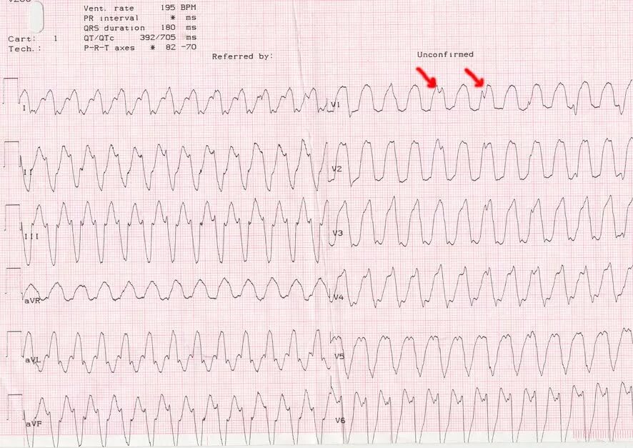 Тахикардия qrs. Пароксизмальная тахикардия с широким комплексом qrs на экг. желудочковая тахикардия с широкими комплексами на экг. наджелудочковая тахикардия на экг. пароксизмальная наджелудочковая тахикардия экг.