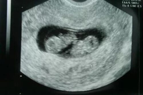 11 недель беременности 2 беременность. УЗИ 10 недель беременности двойня. УЗИ 10 недель беременности Близнецы. УЗИ 11 недель беременности двойня. УЗИ 13 недель беременности двойня.