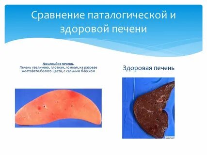 Дистрофия печени и почек