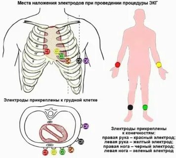 Перепутанные электроды