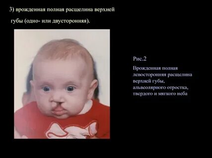 Мкб 10 расщелина мягкого