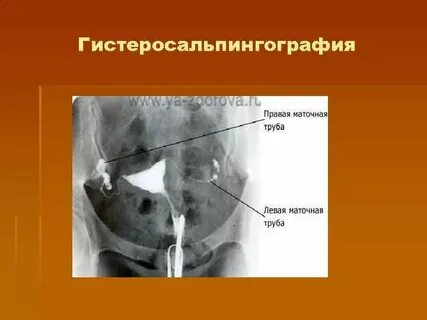 Гсг маточных труб