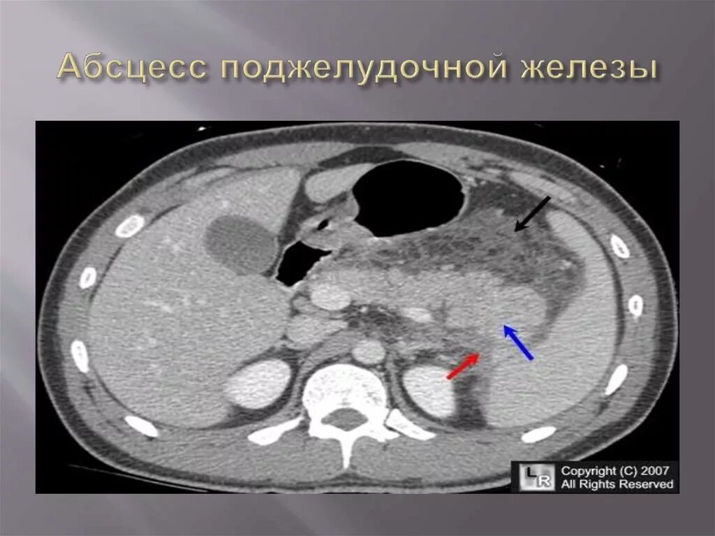 Фиброзные изменения поджелудочной