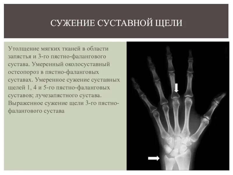 Первый запястно пястный сустав. Эндопротезирование межфаланговых суставов кисти. проксимальные межфаланговые суставы кисти. пястно фаланговые суставы. ревматоидный артрит пястно фаланговый.