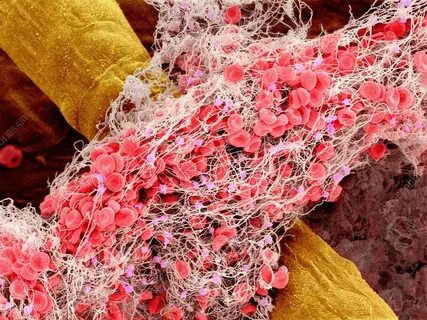 Real clot