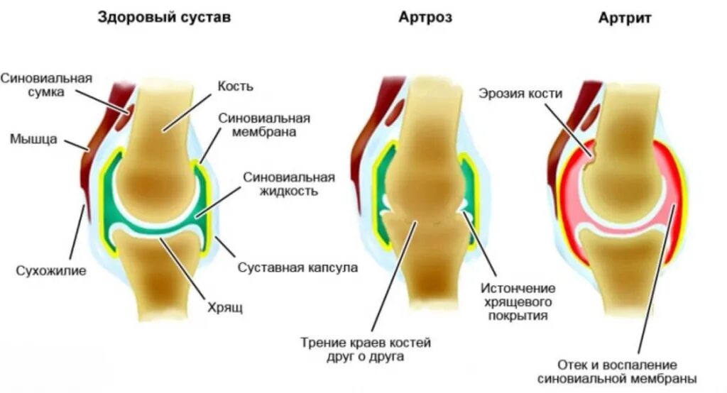 Хрустят хрящи. Деформирующий остеоартроз коленного сустава. Хрустят хрящи. Синовит артроз коленного сустава. Хрящевая ткань коленного сустава.
