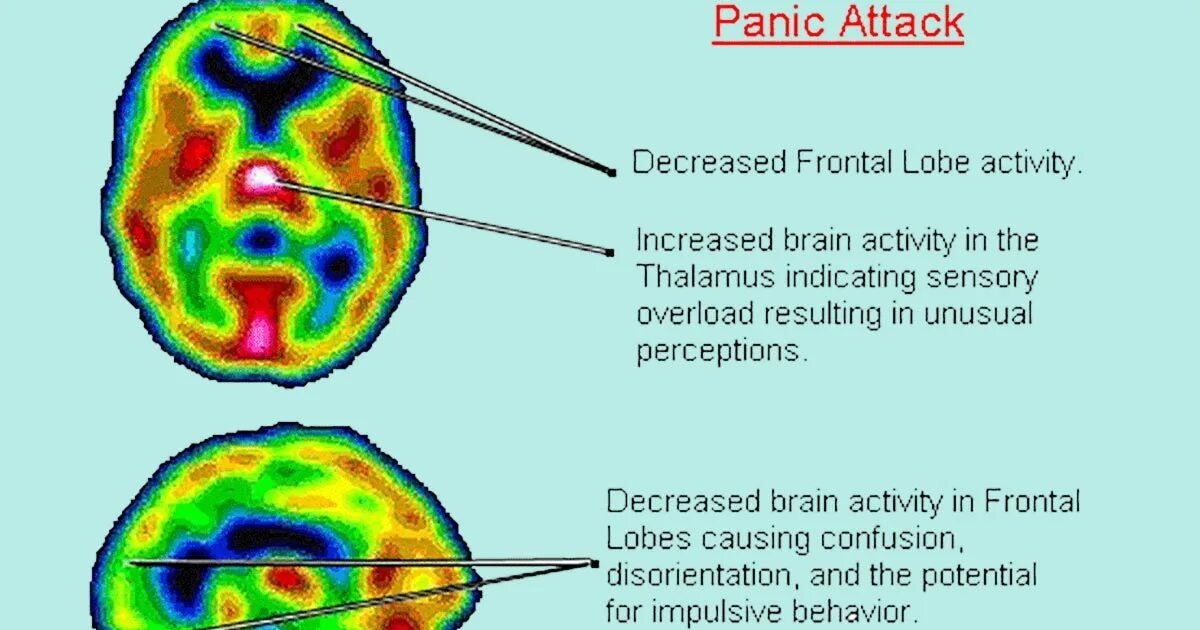 Паническая атака мозг. Мозг при панической атаке. Паническая атака головного мозга. Panic Attack. Серотонин и панические атаки.