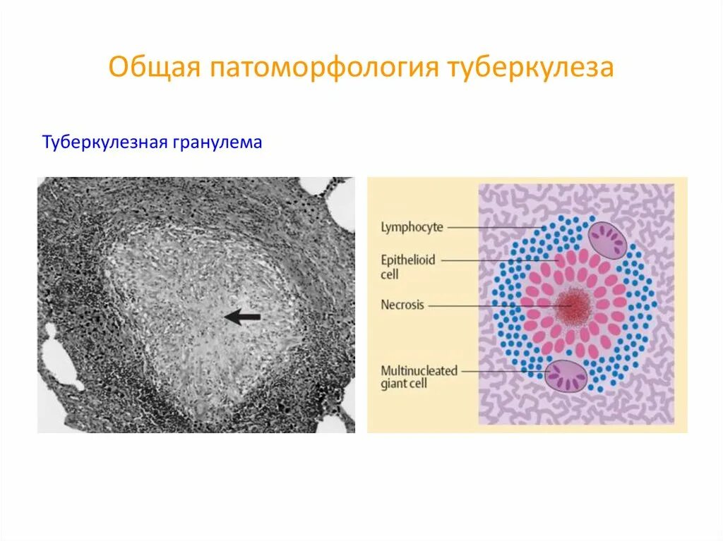 Зоны гранулемы. Зоны гранулемы. Грануляционная ткань гистология. Саркоидная гранулема гистология. Реактивная гиперплазия лимфоузла микропрепарат.