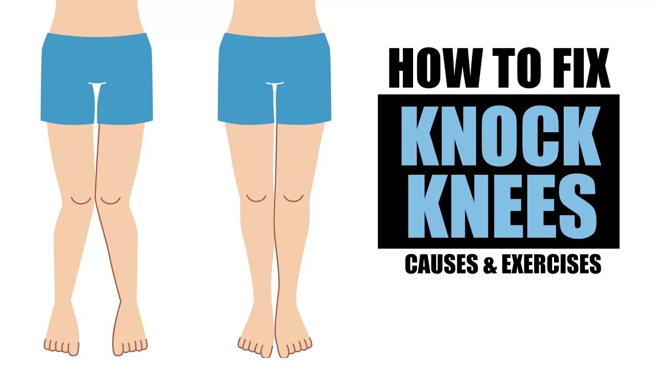 Knock Knees exercises. Problem Knee. How to Fix. How to fix this