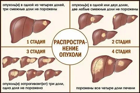 Первый признак рака печени у женщин