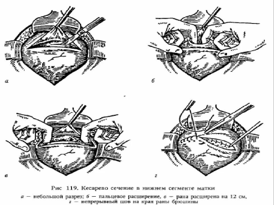 Как сокращается матка после кесарева. Кесарево сечение по Пфанненштилю ход операции. Техника операции кесарева сечения в Нижнем маточном сегменте. Кесарево сечение в Нижнем сегменте поперечным разрезом. Экстраперитонеальное кесарево сечение.
