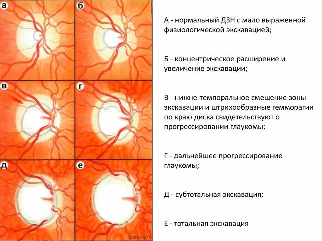 Размеры зрительных нервов. Глаукомная экскавация ДЗН. Экскавация зрительного нерва норма. Экскавация глазного дна. Глазное дно глаукоматозная экскавация.