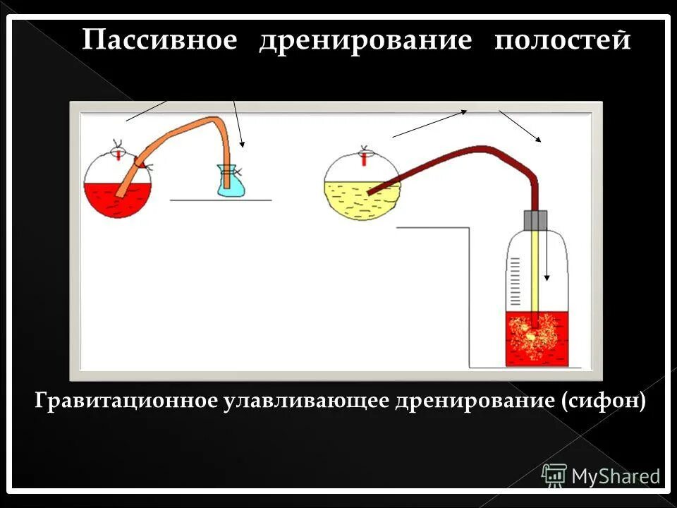 Пассивное дренирование. Пассивное дренирование. Активное дренирование схема. Активное дренирование раны. Пассивные методы дренирования.
