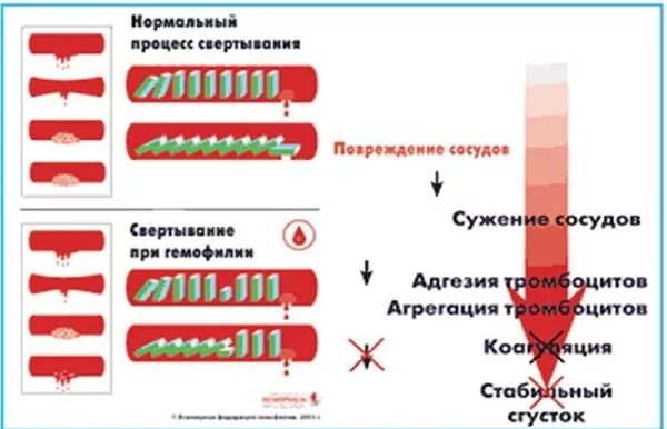 Гемофилия у детей патогенез. Гемофилия патогенез схема. Гемофилия свертывание крови. Гемофилия у детей этиология.