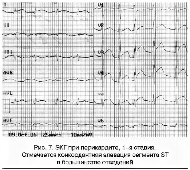 Смещение st вверх v4 v5. Элевация сегмента st на экг v2 v3. элевация сегмента st на экг. элевация st при перикардите. конкордантное смещение st.