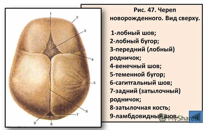 Стреловидный шов головки плода. Сагиттальный шов черепа новорожденного. стреловидный шов черепа новорожденного норма. швы головки новорожденного. венечный шов у новорожденного.