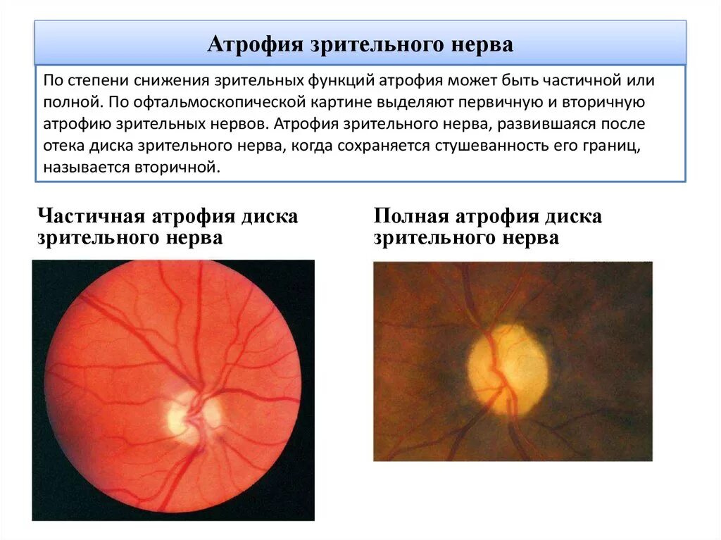 Место выхода зрительного нерва не воспринимающее лучей. Клинические признаки поражения зрительного нерва. Врожденная атрофия зрительного нерва. Неврит зрительного нерва (воспаление зрительного нерва). Атрофия зрительного нерва Лебера.