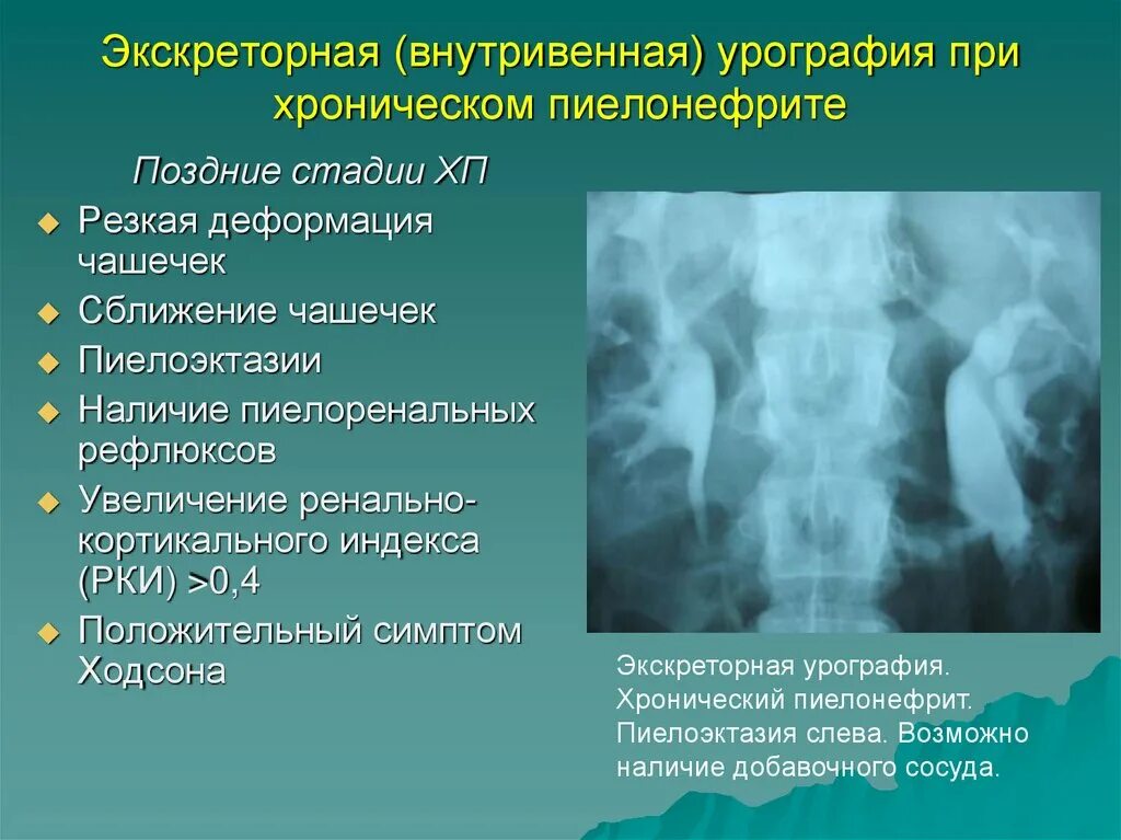 Исследования при пиелонефрите. Острый пиелонефрит обзорная урография. Хронический пиелонефрит экскреторная урография. Внутривенная экскреторная урография. Экскреторная урография при хроническом пиелонефрите.