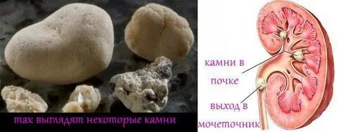 Камень из почек выходит признаки