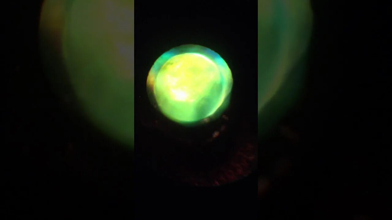 Ядерный склероз. Ядерный склероз. Пленчатая врожденная катаракта. Капсулярная катаракта. Возрастная ядерная катаракта.