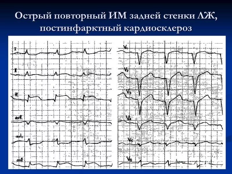 Изменение миокарда передне перегородочной области. Признаки заднего инфаркта миокарда на ЭКГ. Инфаркт миокарда задней стенки на ЭКГ. ЭКГ ИБС постинфарктный кардиосклероз. ЭКГ при ИБС: постинфарктный кардиосклероз.