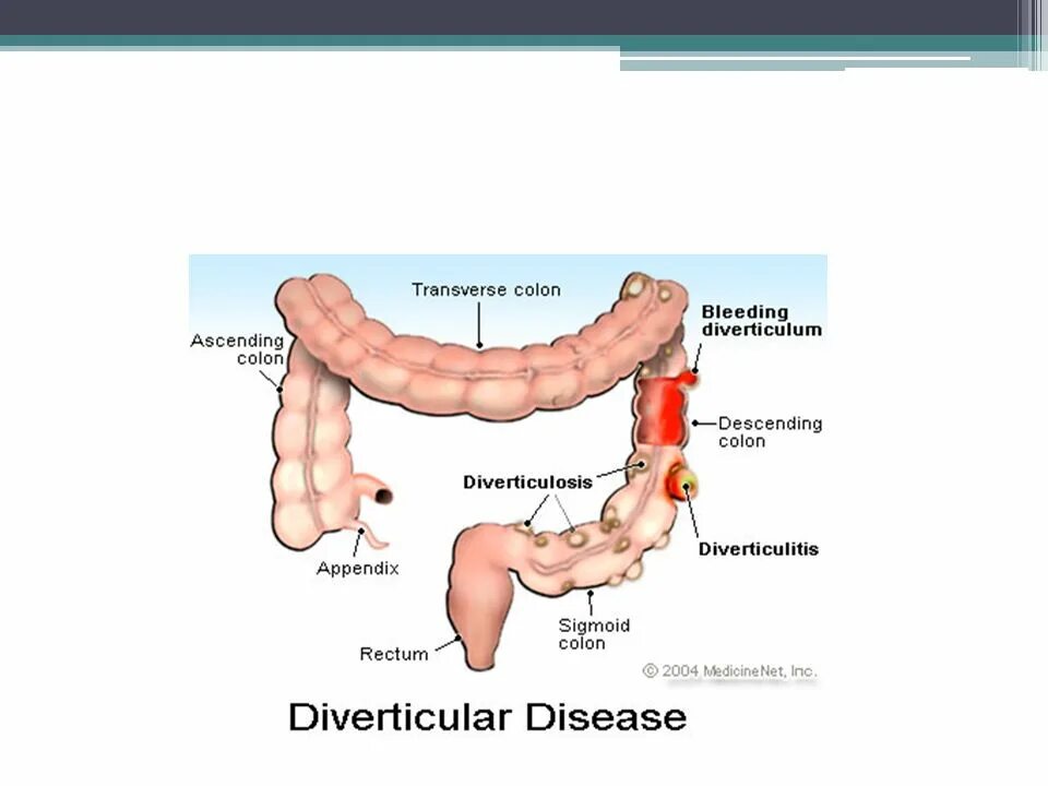 Дивертикулярная болезнь и дивертикулит. Дивертикулит Толстого кишечника. Патогенез дивертикулярной болезни толстой кишки. Дивертикулит этиология. Дивертикулез сигмовидной кишки диета лечение
