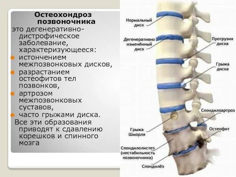 Дегенеративно дистрофические изменения пояснично крестцового. Дегенеративные изменения шейного отдела. с остеохондрозом берут в армию. дорсалгия позвоночника. берут ли в армию с остеохондрозом поясничного отдела.