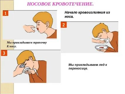 Что делать при носовом кровотечении
