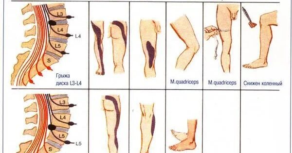 Боль в ноге дифференциальный диагноз. Болит поясница отдает в ногу. Боль в спине отдает в ногу.