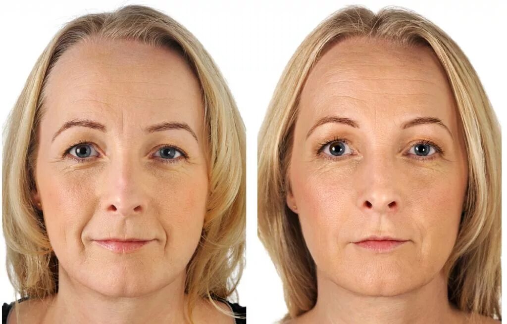 Маски для лица до и после. Мимические морщины носогубные. Лицо с морщинами до и после. Омоложение лица до и после. Фейслифтинг для лица.