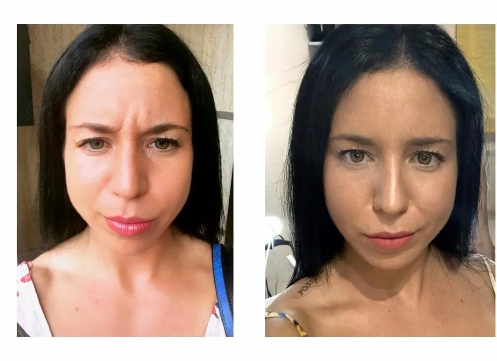 Что нельзя делать после ботокса на лице