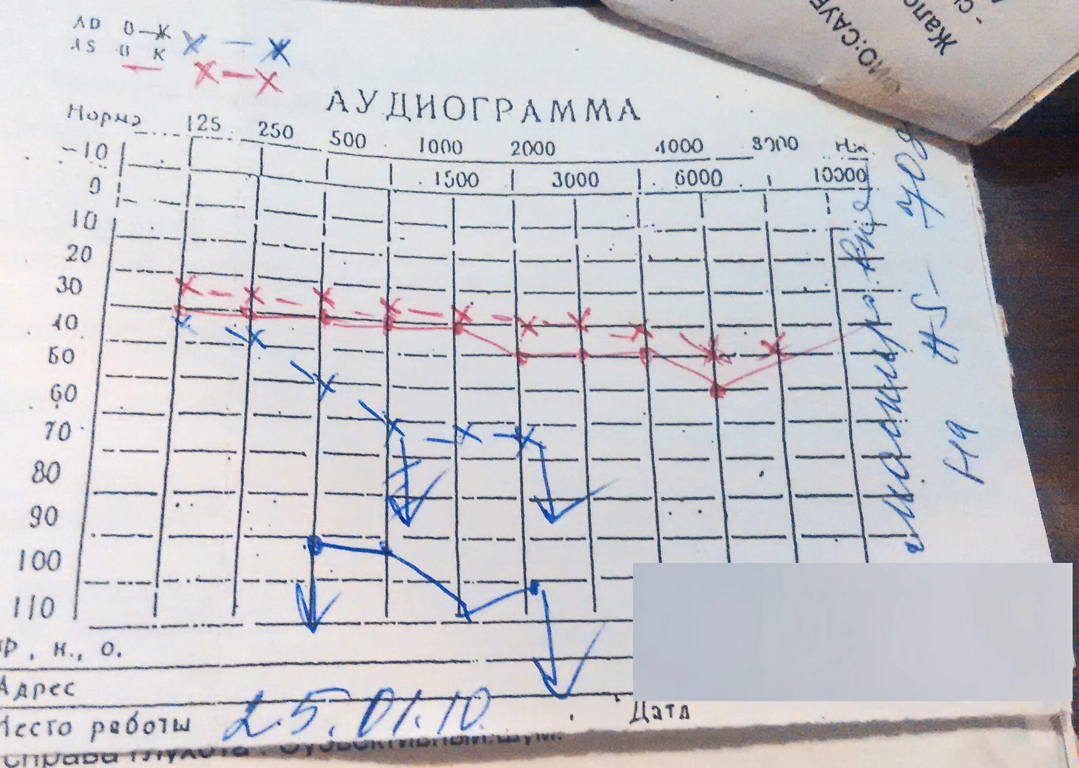 Аудиограмма слуха норма. Аудиограмма 4 степени тугоухости. Отосклероз аудиограмма. Заключение по аудиограмме. Аудиограмма степени