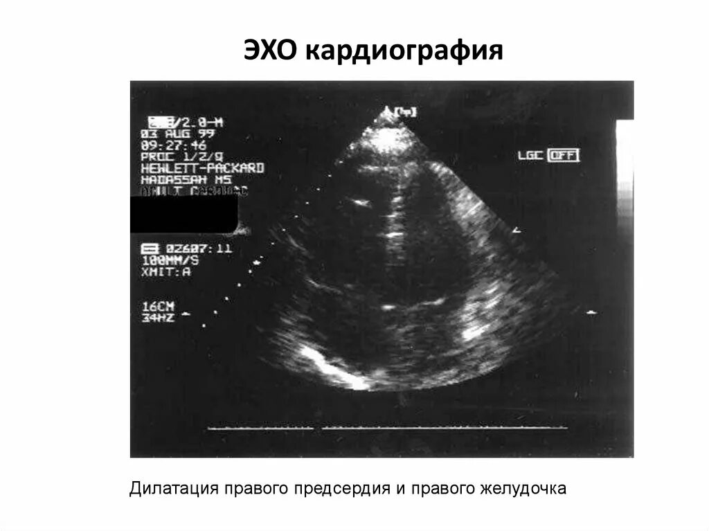 Дилатация правых отделов. Дилатация правого желудочка ЭХОКГ. ГЛЖ на ЭХОКГ. Дилатация левого желудочка ЭХОКГ. Дилатация эхокардиография.