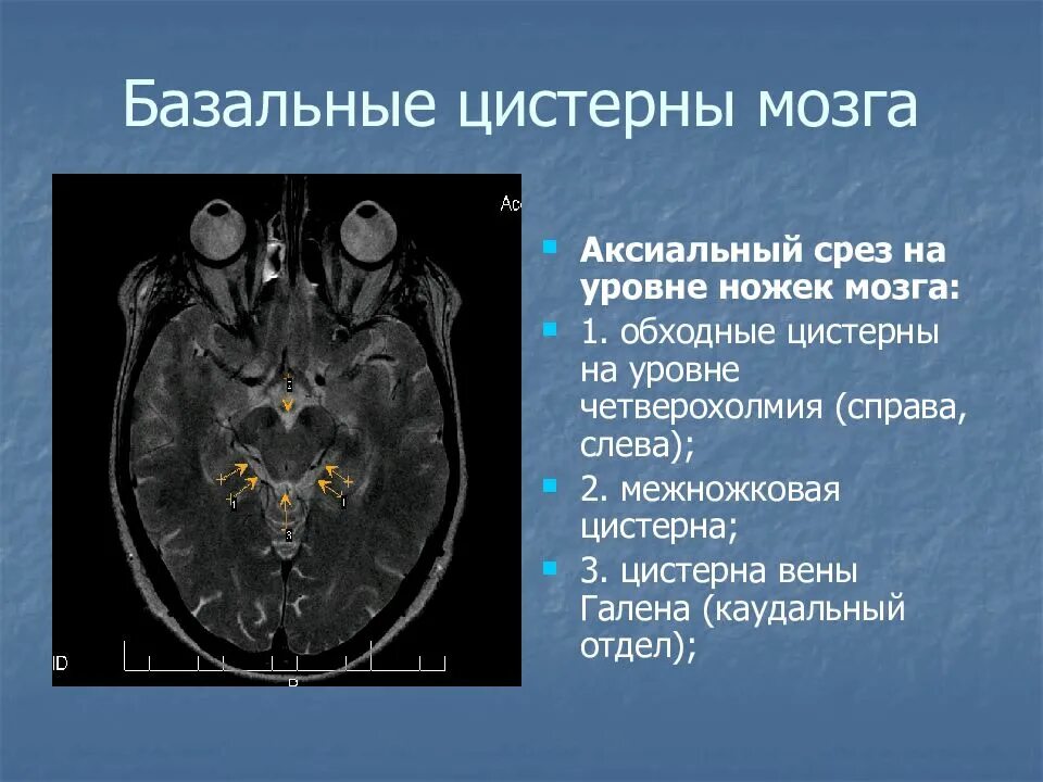 Цистерны на кт. Мостомозжечковая цистерна мрт. цистерна латеральной ямки мозга. супраселлярная цистерна мрт. киста четверохолмной цистерны мрт.