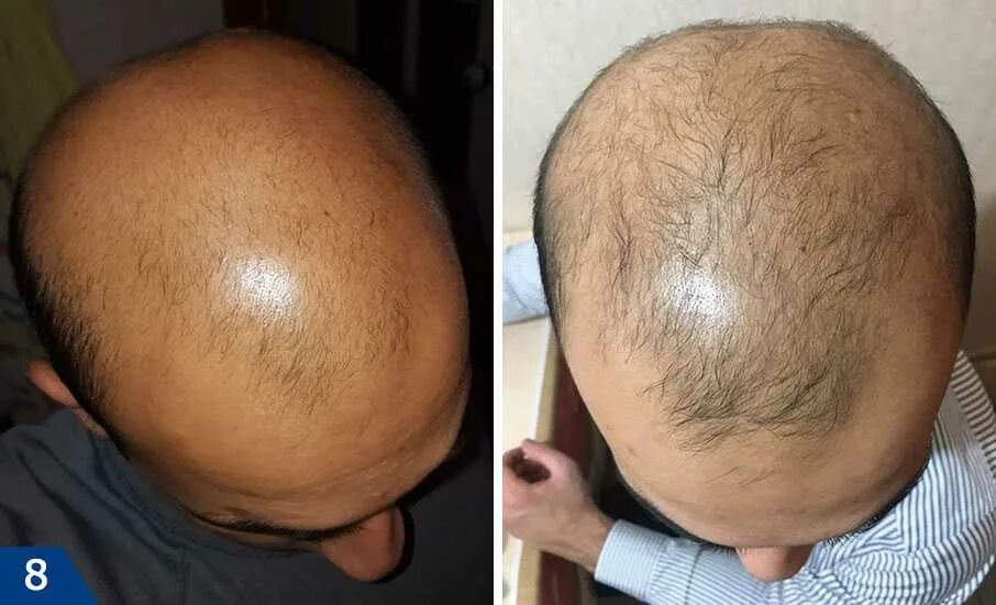Мезотерапия волос до и после. Мезотерапия головы. Мезо волос до и после. Мезотерапия волос до и после фото.