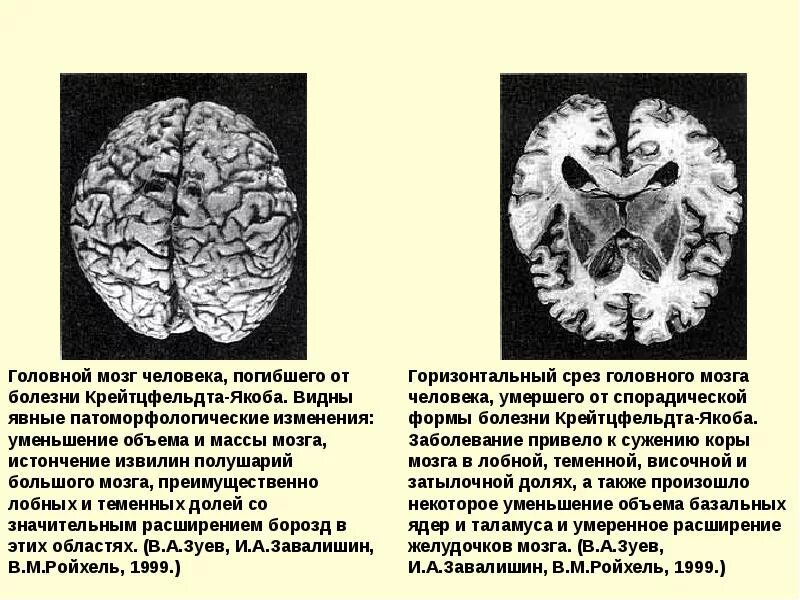 Поражение мозга болезнь. Прионы болезнь Крейтцфельдта Якоба. Болезнь Крейтцфельдта-Якоба мозг. Прионы губчатая энцефалопатия. Головной мозг при болезни Крейтцфельдта Якоба.