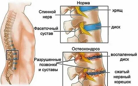 Поясничный остеохондроз код