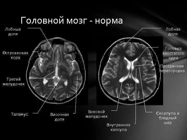 Пластина мозга. Цистерны головного мозга на мрт анатомия. Желудочки головного мозга кт анатомия. Базальные цистерны головного мозга кт. Прозрачная перегородка мозга кт.