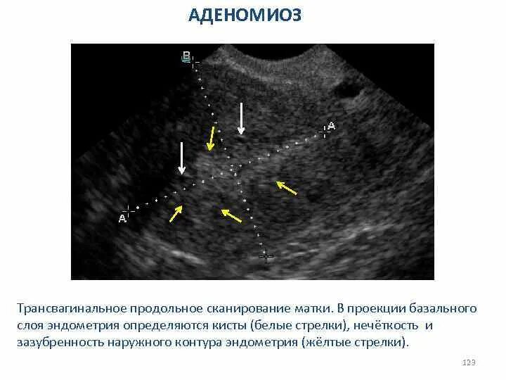 УЗИ протокол аденомиоза матки. Базальный слой эндометрия. Эндометрий базальный слой