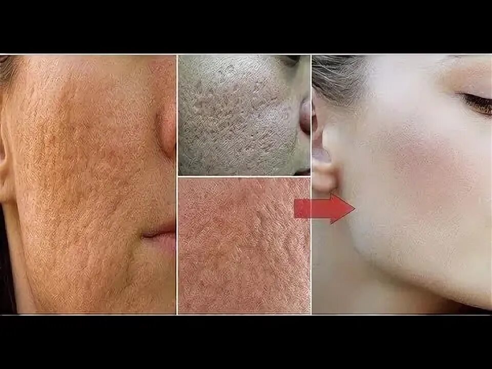 Как выглядят поры на лице How to Get Rid of Large Pores in 3 Days Get Smooth, Fairer and Tighter Skin Skin